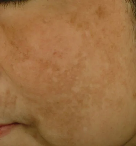 Fig 3. Mottled facial hyperpigmentation (melasma/PIH pattern) across the cheek of a Fitzpatrick IV-V patient.